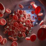 ¿Puedo consumir cerveza si estoy tomando Sintrom (anticoagulante)?