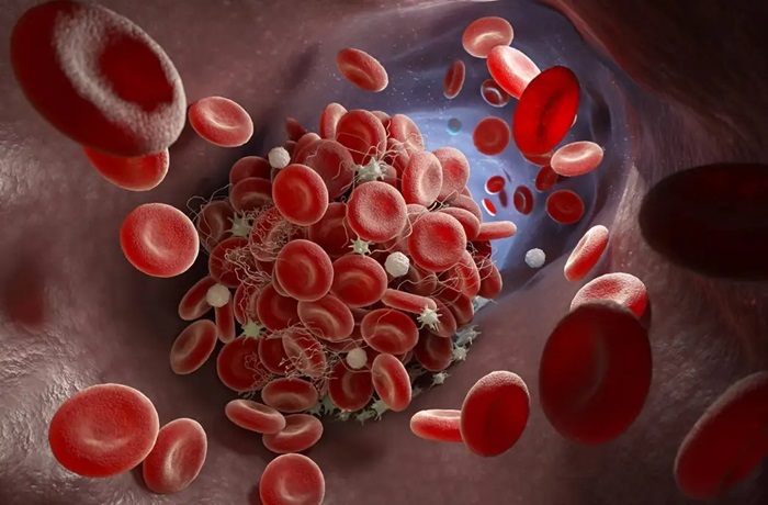 ¿Puedo consumir cerveza si estoy tomando Sintrom (anticoagulante)?