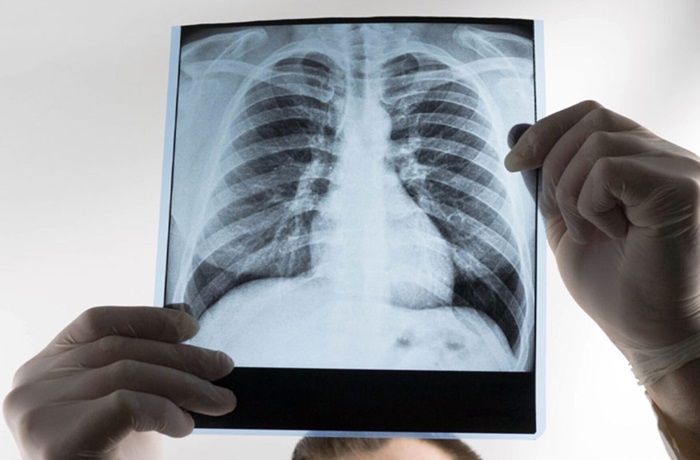 Cerveza y salud pulmonar: ¿Qué dice la ciencia sobre sus efectos? 1 Cerveza y salud pulmonar